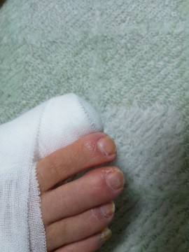 足の指先を覆う包帯の巻き方-後は基本通り環行で終わります。